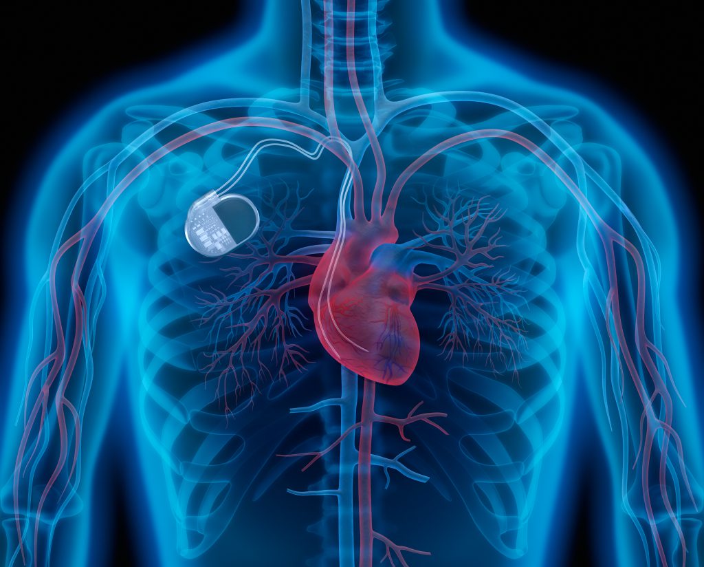 การใส่เครื่องกระตุ้นไฟฟ้าหัวใจในร่างกาย