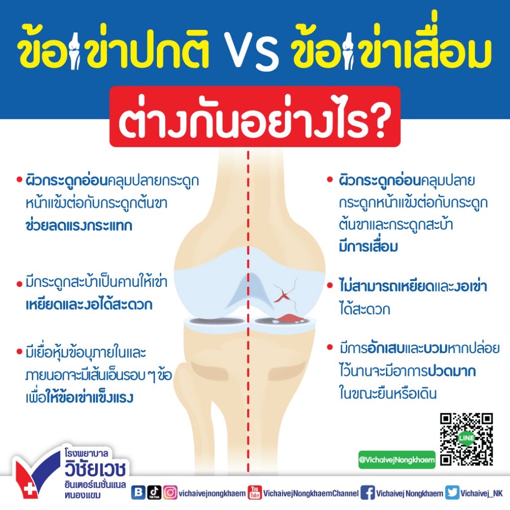 ข้อเข่าปกติกับข้อเข่าเสื่อม ต่างกันอย่างไร?