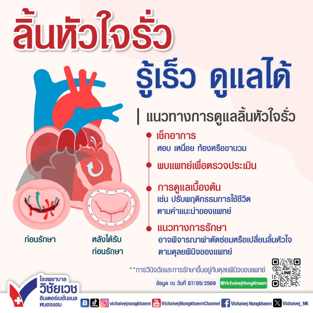ลิ้นหัวใจรั่ว รู้เร็ว ดูแลได้