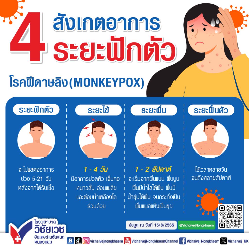 สังเกตอาการ 4 ระยะฟักตัว โรคฝีดาษลิง