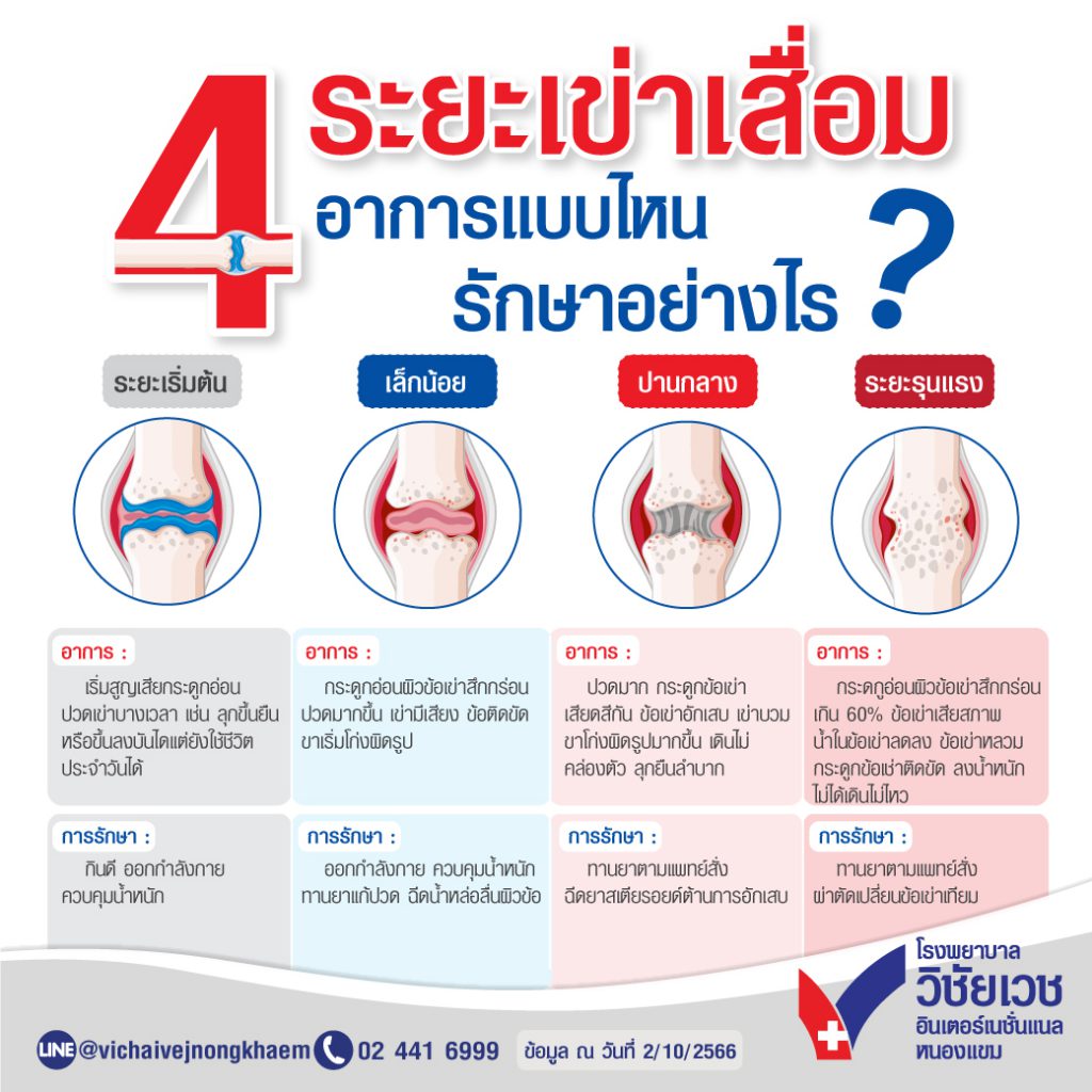 4 ระยะเข่าเสื่อม อาการแบบไหน รักษาอย่างไร?