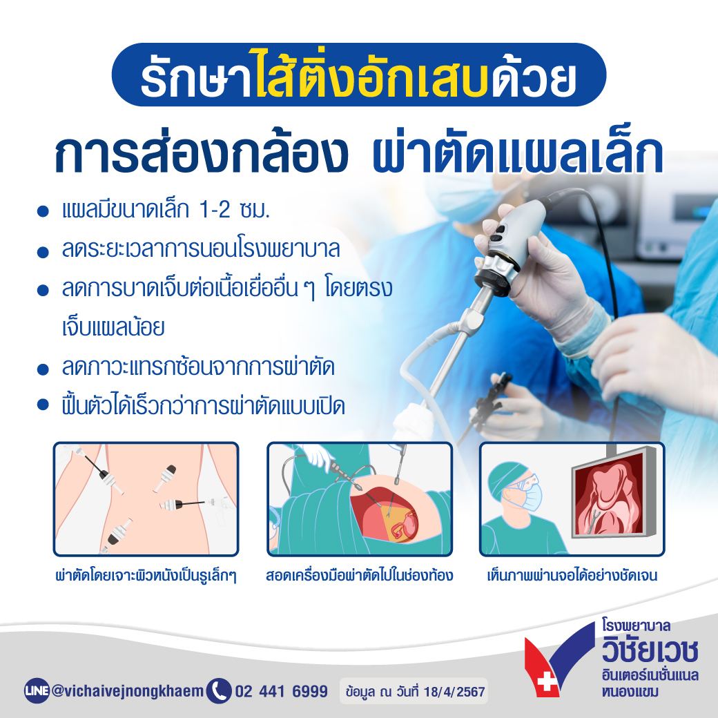 รักษาไส้ติ่งอักเสบด้วยการส่องกล้อง ผ่าตัดแผลเล็ก - โรงพยาบาลวิชัยเวช อินเตอร์เนชั่นแนล หนองแขม