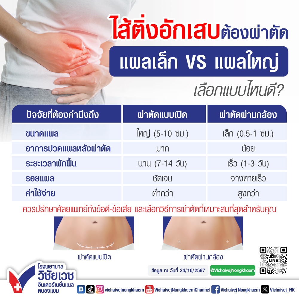 ไส้ติ่งอักเสบต้องผ่าตัด แผลเล็ก VS แผลใหญ่ เลือกแบบไหน - โรงพยาบาลวิชัยเวช อินเตอร์เนชั่นแนล หนองแขม