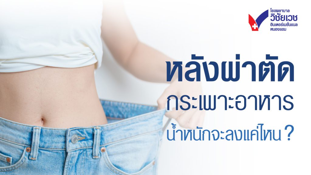 หลังผ่าตัดกระเพาะ: น้ำหนักจะลดลงแค่ไหน?