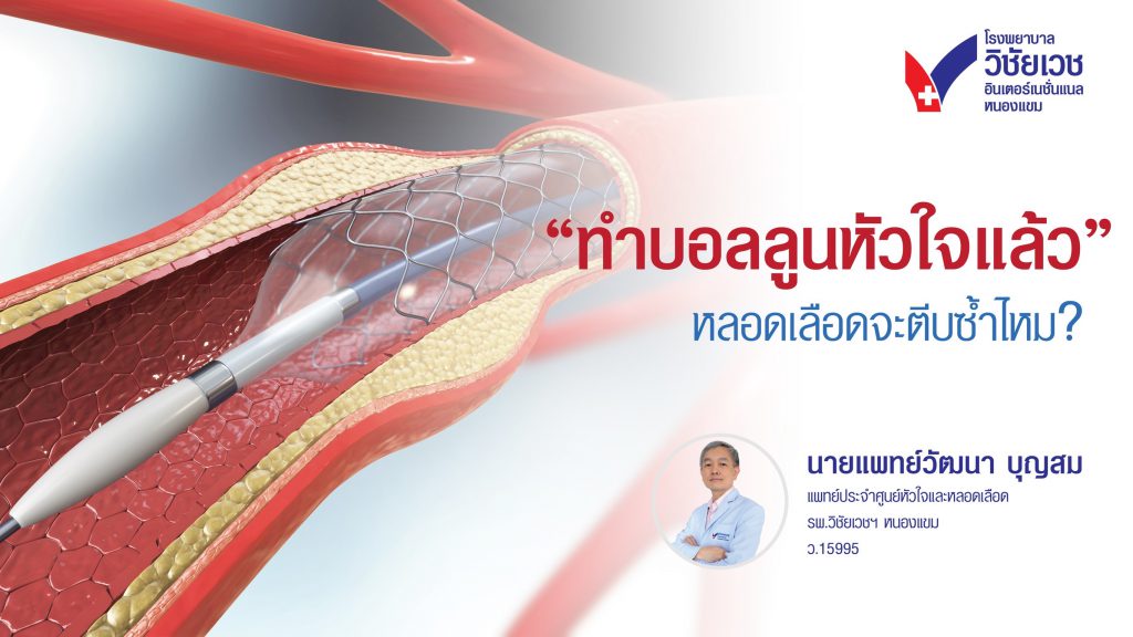 ทำบอลลูนหัวใจแล้ว หลอดเลือดจะตีบซ้ำไหม?