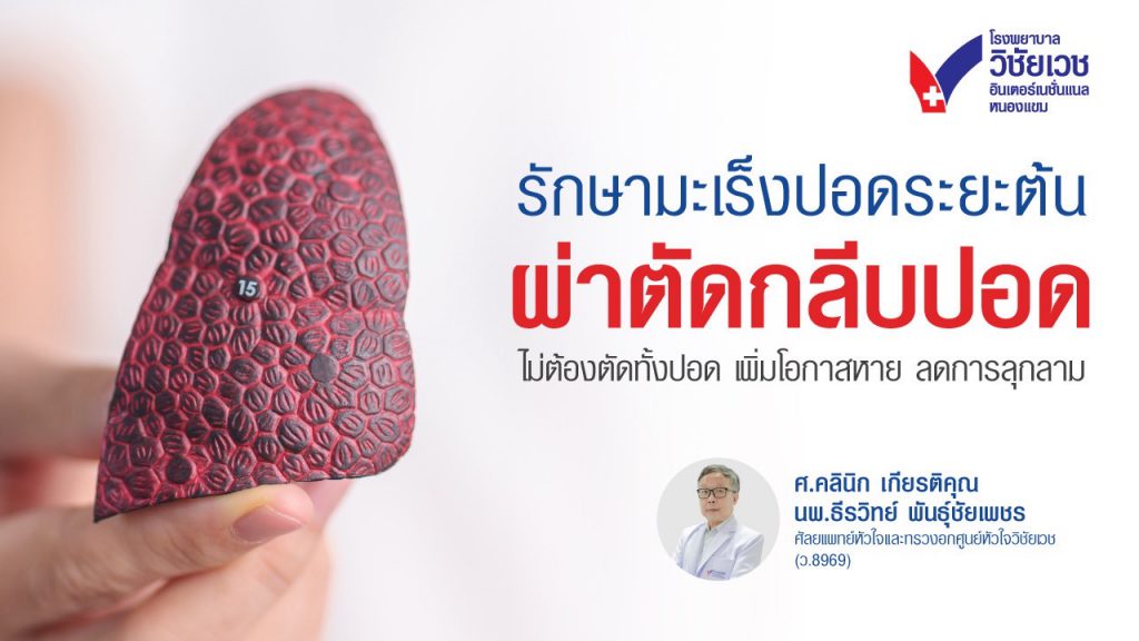 รักษามะเร็งปอดระยะต้นด้วยการผ่าตัดตัดกลีบปอด เพิ่มโอกาสหาย ลดการลุกลาม