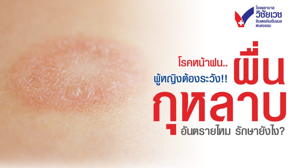 โรคหน้าฝน ผู้หญิงต้องระวัง ผื่นกุหลาบ อันตรายไหม รักษายังไง