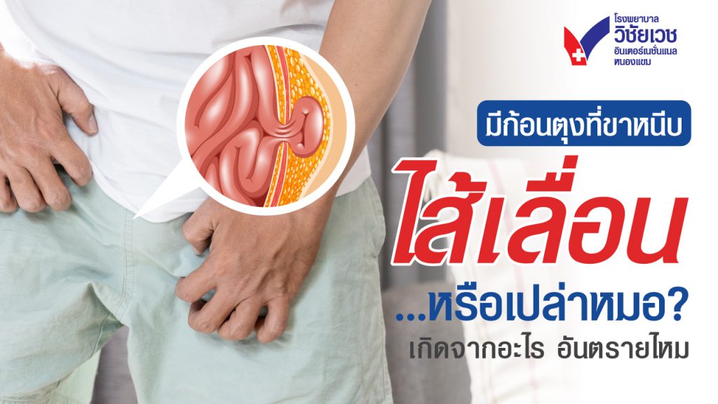 มีก้อนตุงที่ขาหนีบ ไส้เลื่อนหรือเปล่าหมอ? ไส้เลื่อนเกิดจากอะไร อันตรายไหม