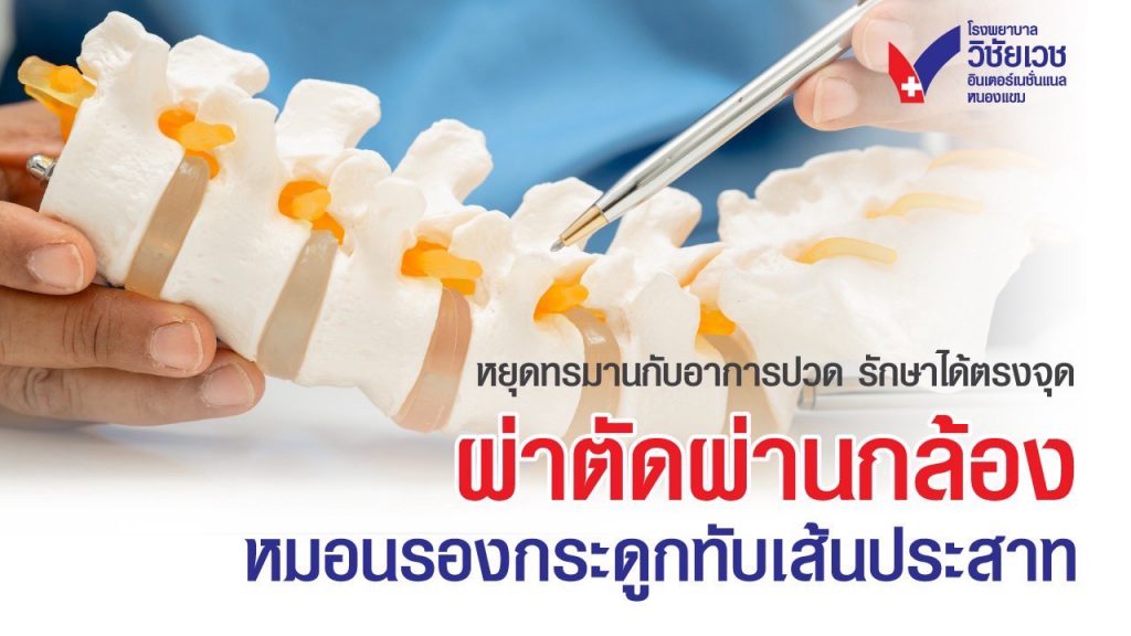 ผ่าตัดหมอนรองกระดูกทับเส้นประสาทผ่านกล้อง เจ็บน้อย ฟื้นตัวไว ทางเลือกใหม่ไม่ต้องผ่าตัดใหญ่