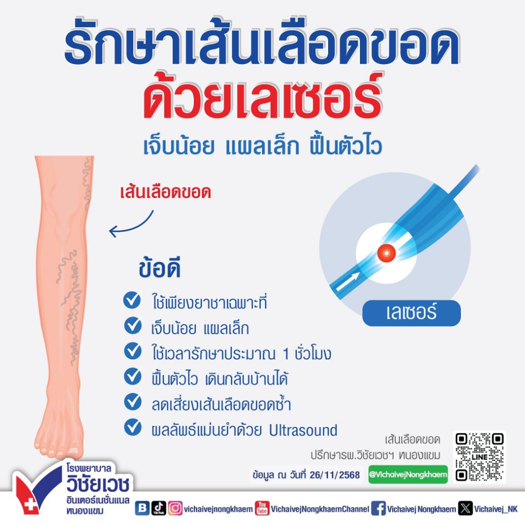 รักษาเส้นเลือดขอดด้วยเลเซอร์ เจ็บน้อย แผลเล็ก ฟื้นตัวไว