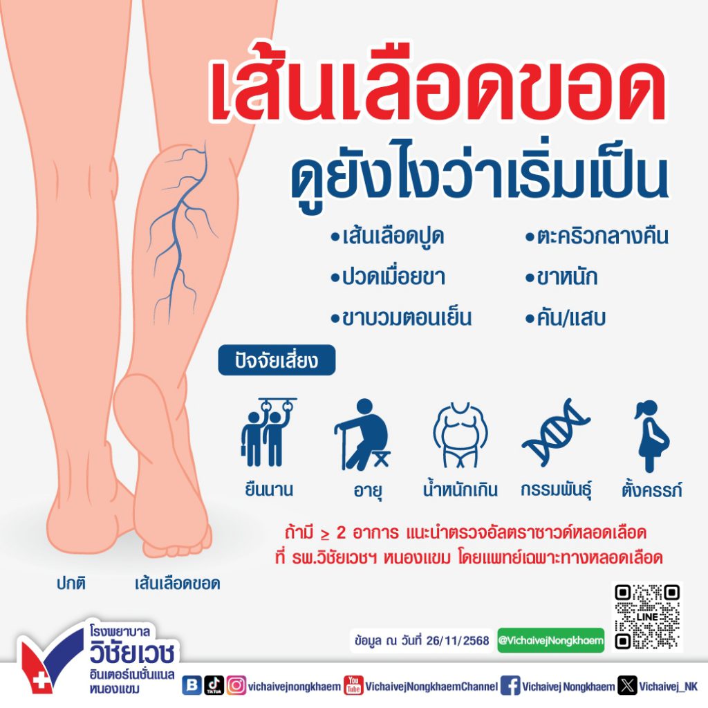 เส้นเลือดขอดดูยังไงว่าเริ่มเป็น