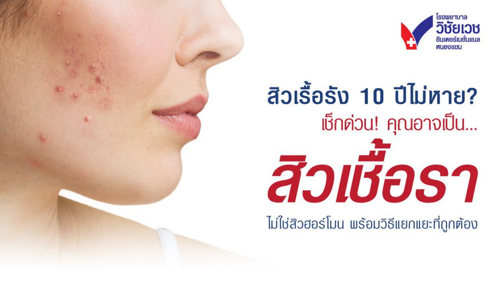 สิวเชื้อรา vs สิวสเตียรอยด์ ต่างกันอย่างไร? ตรวจหาเชื้อสิวให้ชัวร์ ที่ รพ.วิชัยเวชฯ หนองแขม