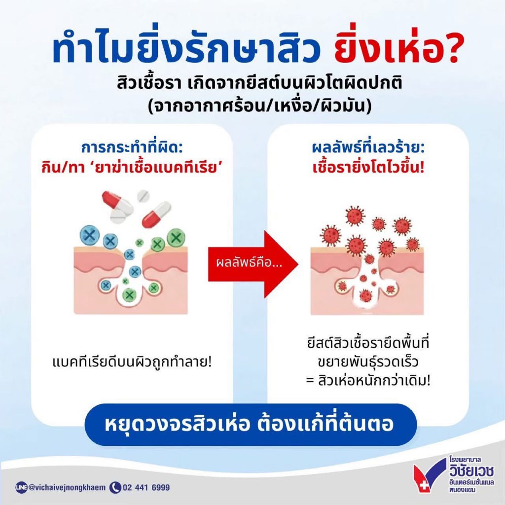 ทำไมยิ่งรักษาสิว ยิ่งเห่อ?