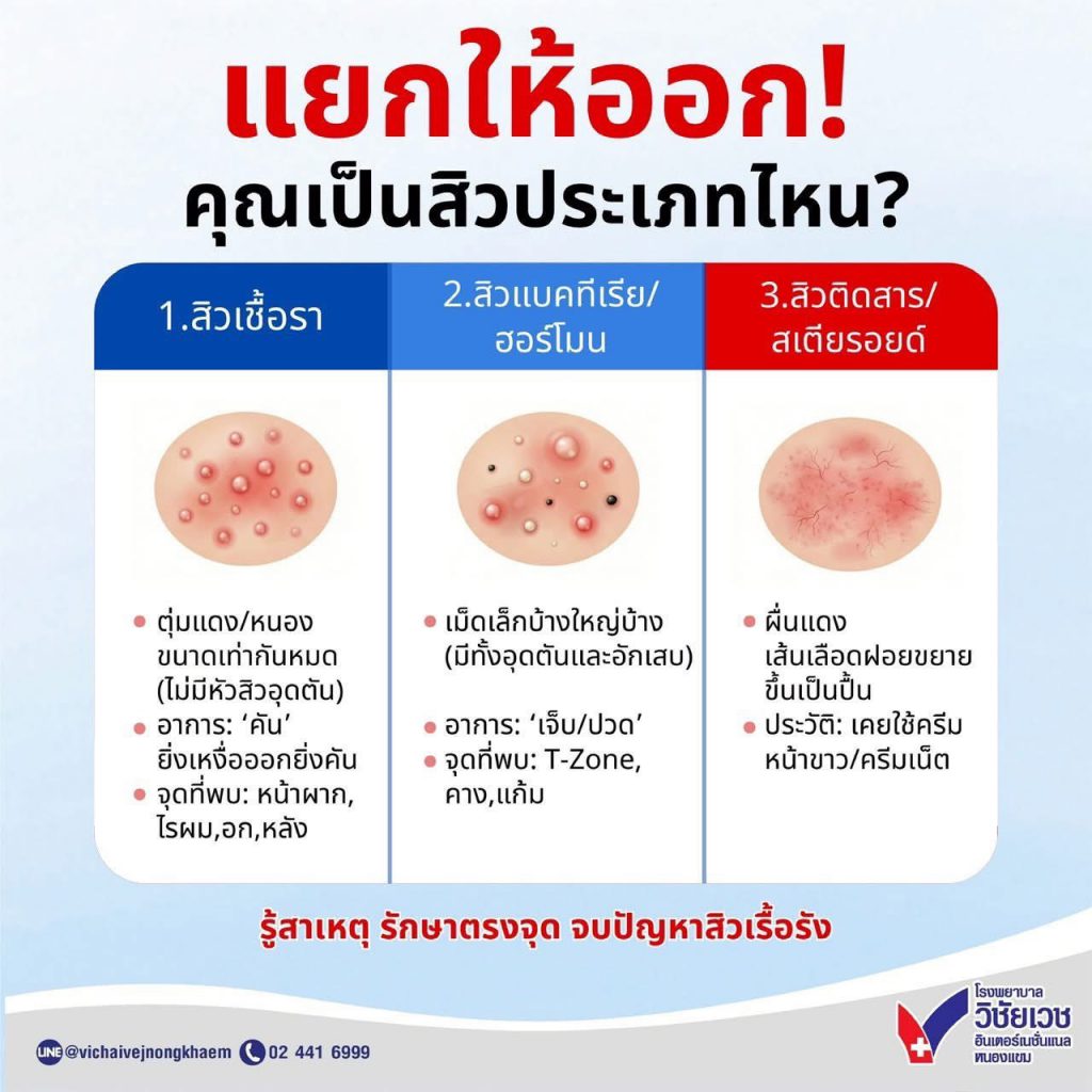 แยกให้ออก! คุณเป็นสิวประเภทไหน?