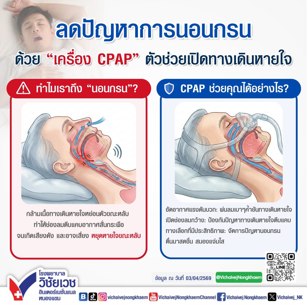 ลดปัญหาการนอนกรนด้วย “เครื่อง CPAP” ตัวช่วยเปิดทางเดินหายใจ