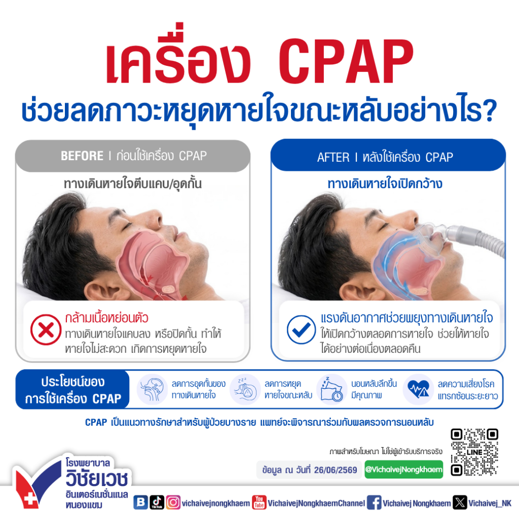 เครื่อง CPAP ช่วยลดภาวะหยุดหายใจขณะหลับอย่างไร?