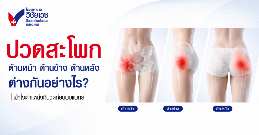 ปวดสะโพกด้านหน้า ด้านข้าง ด้านหลัง ต่างกันอย่างไร?