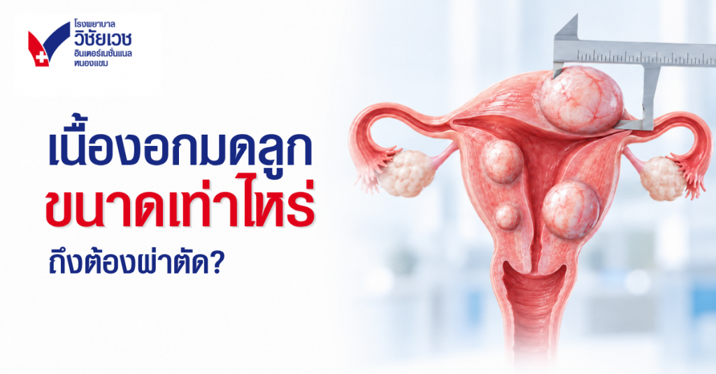 เนื้องอกมดลูก ขนาดเท่าไหร่ต้องผ่าตัด? รู้จักปัจจัยสำคัญที่ใช้ประกอบการรักษา
